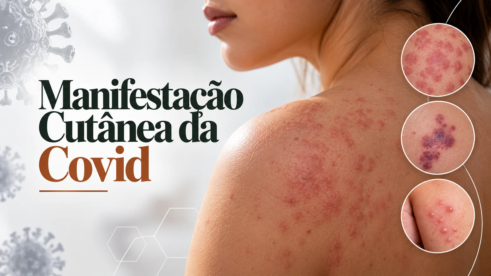 Manifestação Cutânea da Covid